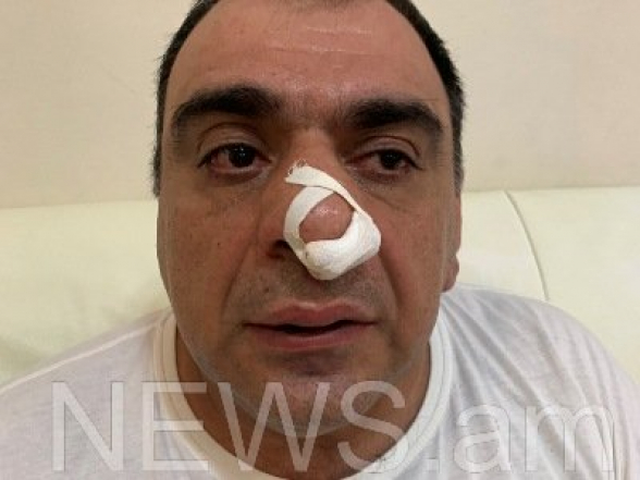 Մոսկվաբնակ գործարարը պնդում է, որ Երևանում Խաչատուր Սուքիասյանի եղբայրն ու թիկնապահն իրեն ծեծի են ենթարկել (լուսանկար)