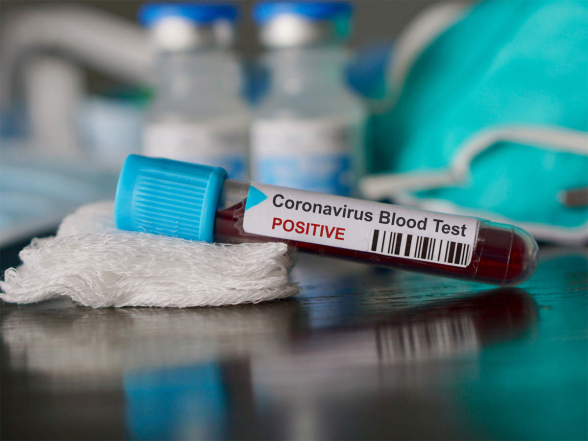 За сутки в Армении выявлено 399 новых случаев коронавируса, скончались еще 19 человек