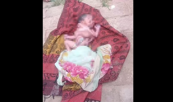 В Индии родился младенец с 2 лицами, 4 ногами и 4 руками